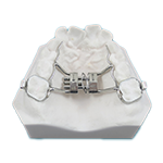 palatal expander